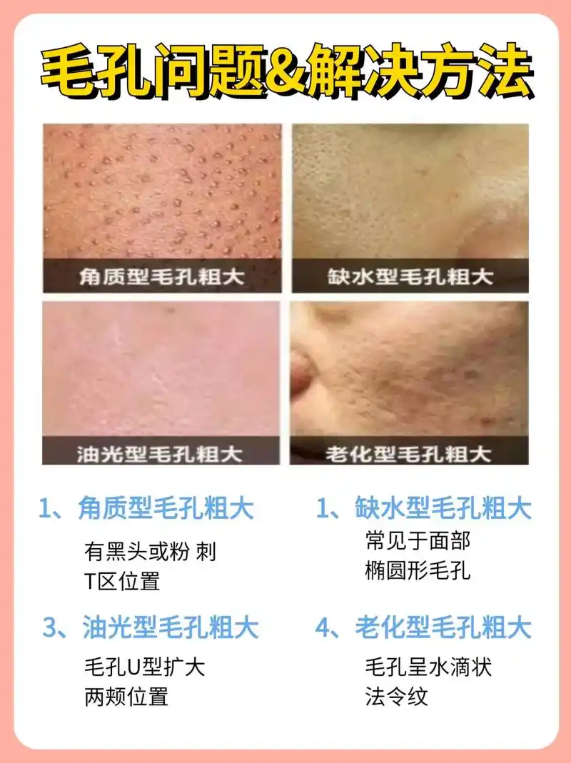 毛孔粗大怎么办71分清毛孔粗大类型正确护肤.