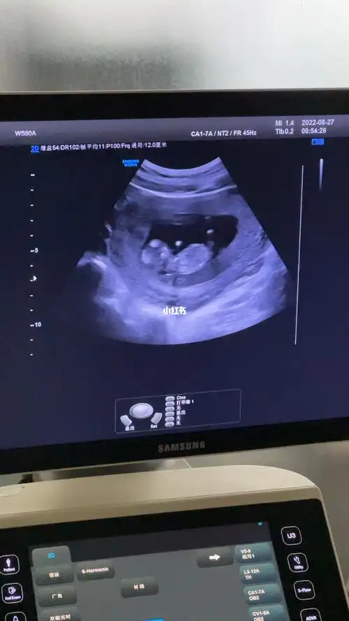 12周nt都说我生女孩几率很大很期待