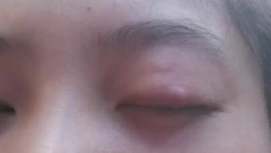 最近眼皮上长了一个小豆,轻轻弄了一下,长成小包咯!涂了一下眼