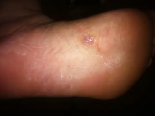 脚底肿了两个胞