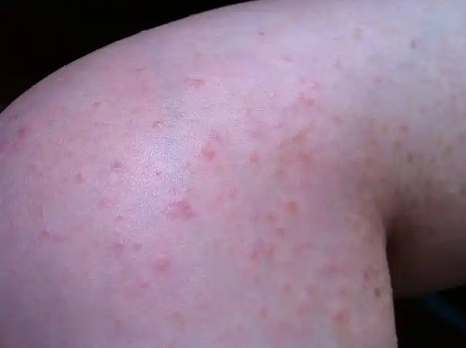 去除暗疮|分享两周去湿疹,一个月去黑头的方法-简单生活