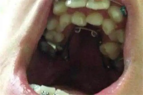 10岁男孩长出双排牙父母还自豪是营养好网友送医院吧