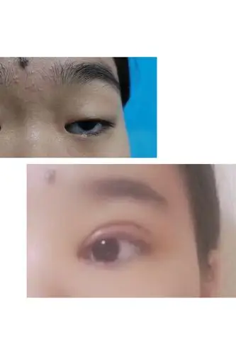 上睑重度肌无力术后案例分享 - 好大夫在线