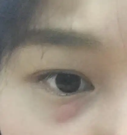 眼睛底下,眼袋处,时不时长个像蚊子咬了一样的小包,有点痒,而且越