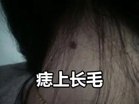 脖子痣上长毛代表福气很好吗