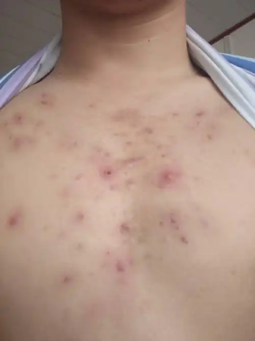 胸张痘痘这是什么,去医院说不知道?