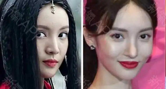 要知道,上一个缩鼻翼出事的女明星还是娜扎,缩鼻翼之后出现