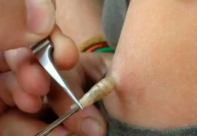 她到非洲工作被蚊虫叮咬结果从手臂里夹出7只蛆