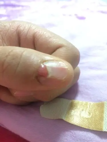 手指甲盖根部凸起,自己拿刀割了,里面的肉都凸起