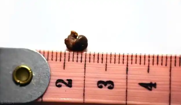 03,磷酸钙结石首先,磷酸钙类结石易在碱性尿中形成,平时应多喝水,适量