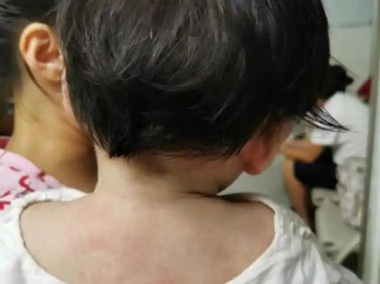 宝宝"歪头"不是萌,当心是肌性斜颈!