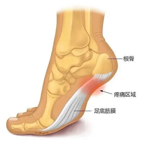 足底筋膜炎它来了,怎么办?快看这里!