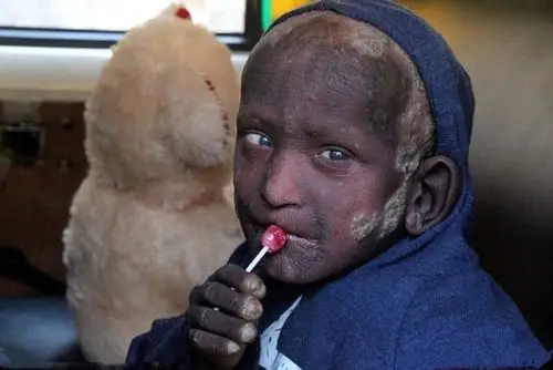 印度男孩患罕见遗传病全身皮肤疑似鱼鳞一洗澡就干裂流血