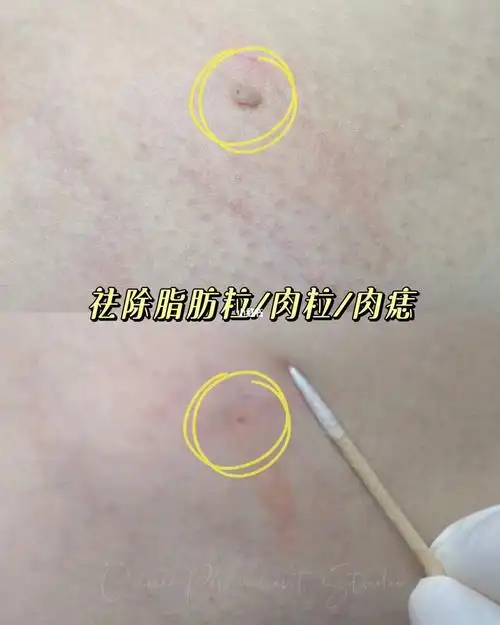 烦人的肉疙瘩怎么解决
