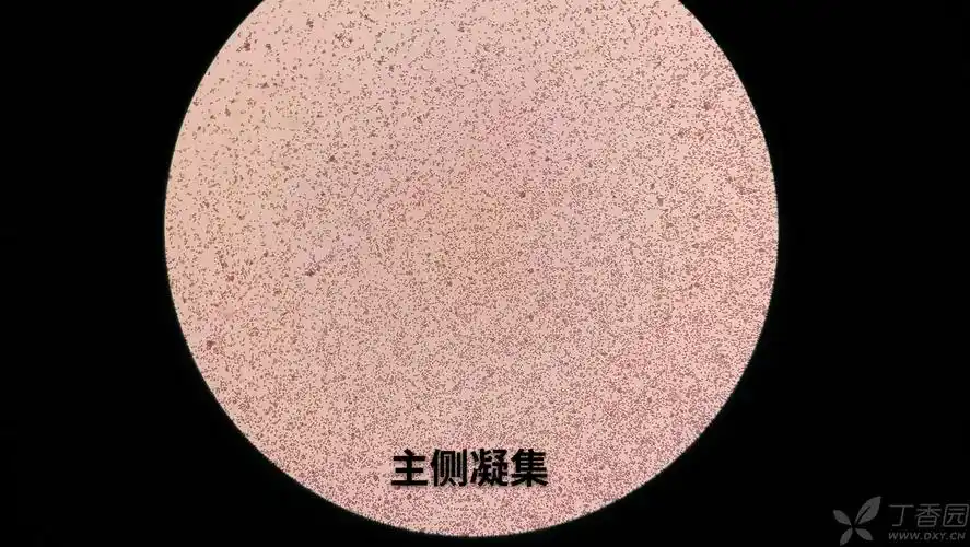 病人抗筛阳性 配血用凝聚胺法 主侧凝集,且试管不可见,但镜下可见