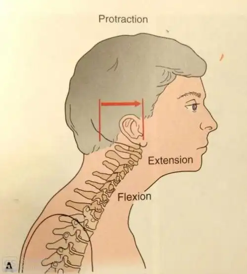 头前倾姿势(forward head posture),又称乌龟脖子