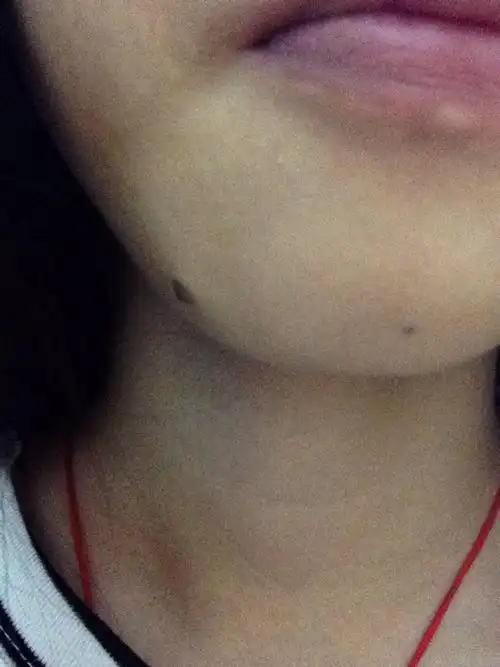 女人嘴下巴有痣好不好(女人嘴下巴有痣好不好图解)