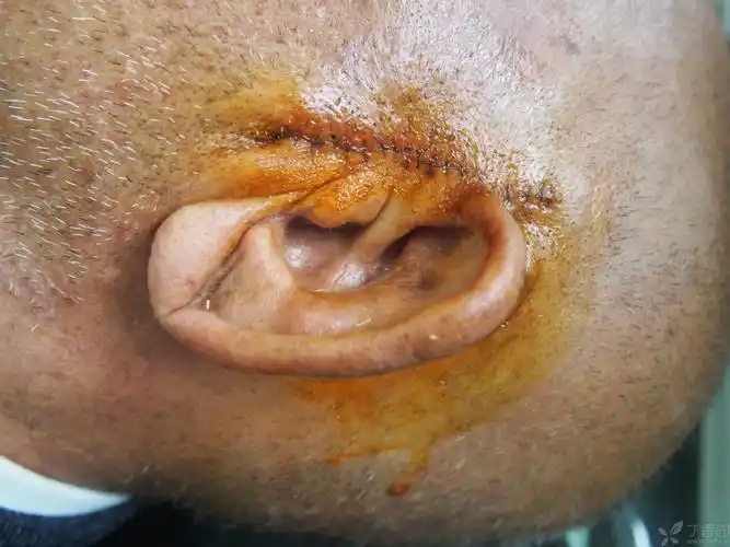 【讨论】耳廓皮肤癌