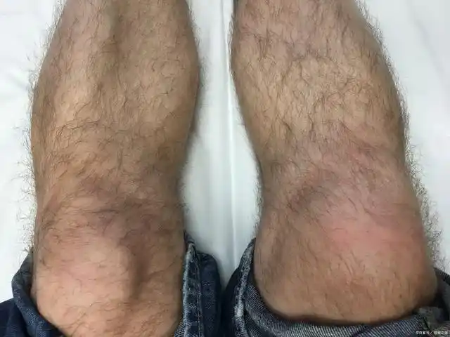 为啥有的男性腿毛多,有的却干干净净?年过50腿毛旺盛,暗示了啥