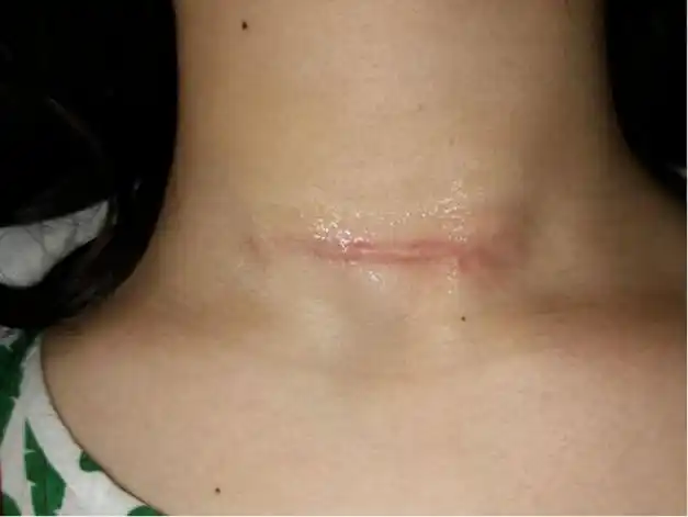 过来人熬夜整理!术后疤痕找对方法才能去掉!赶紧来看!