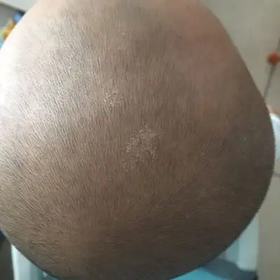 宝宝头上最近长了类似头藓的东西,这是什麼原因造成的呢?