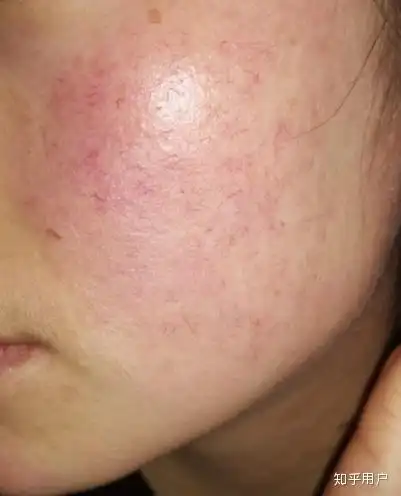 皮肤很不好,脸部角质层薄导致皮肤敏感,很难看,求大神指点?