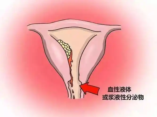 宫颈癌早期症状708090后女性必看