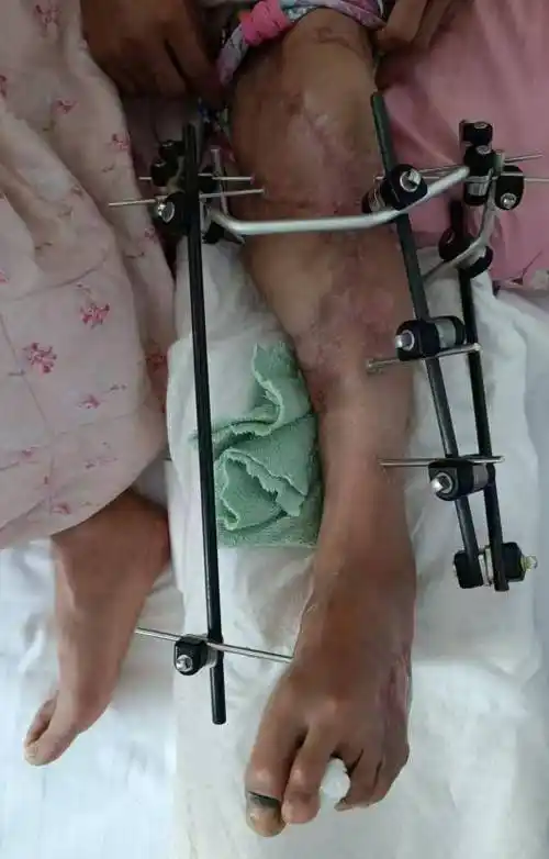 【医患携手路】截肢边缘患者重获新生 医生妙手回春创造希望