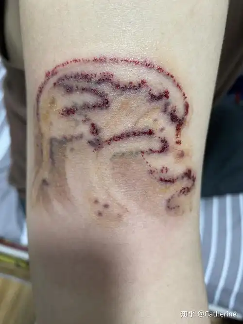 洗纹身恢复全过程记录