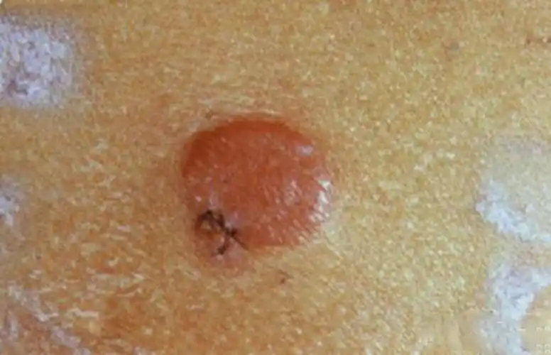 脖子淋巴瘤早期图片_有来医生