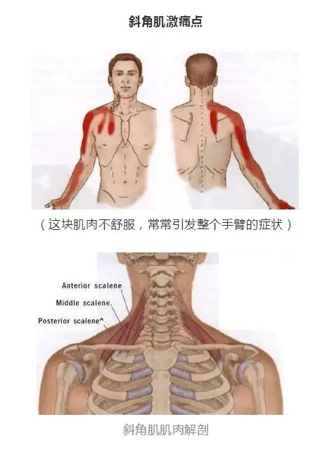 影响颈椎疼痛的一条肌肉斜角肌