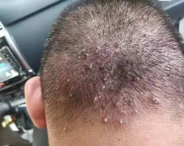 夏天来了头皮毛囊炎怎么办医生提醒三点建议或可消退