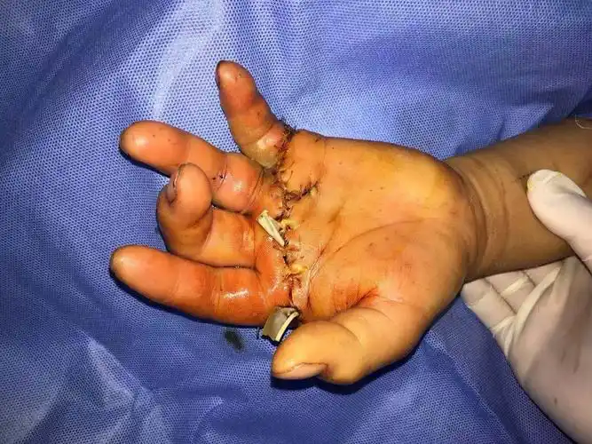 其它 左手掌断裂 写美篇患者 女性  47岁,因"重物砸伤致左手疼痛,流血