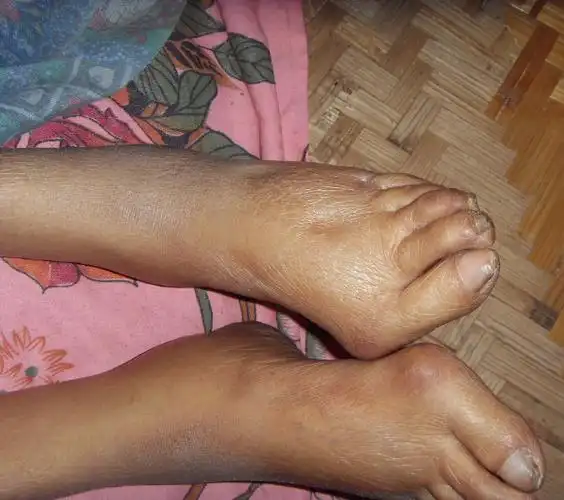 浮肿图 (28)_有来医生