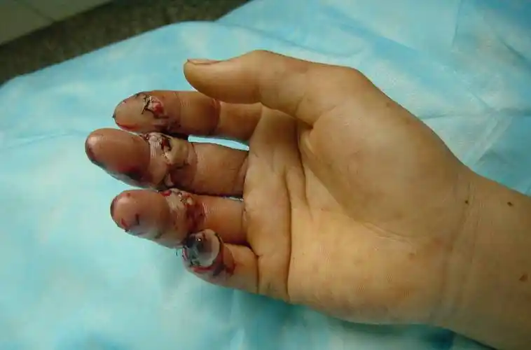 各种疾病及损伤所致四肢各种缺损的修复,复杂性四肢离断的再植,手指的