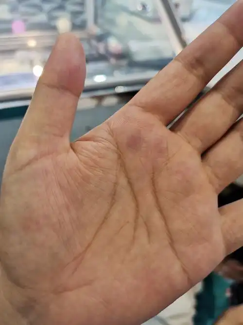 手掌突然淤青怎么回事