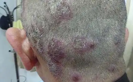 头皮牛皮肤癣传染吗图片症状有哪些表现