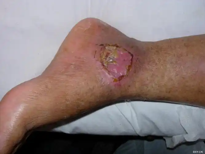 左内踝巨大溃疡