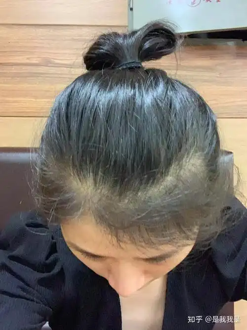 真实生发史记录 - 知乎