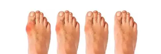 脚趾的痛——【拇外翻】可不只是难看而已