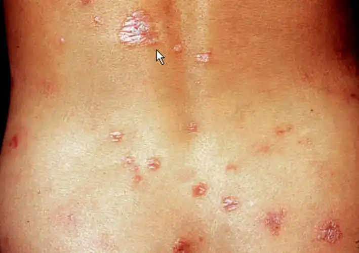 早期梅毒感染症状图图片