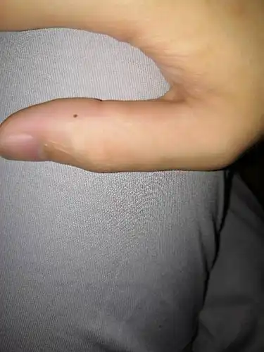 我想说我这大拇指边上的小痣是什么意思呀!哪位大神能帮我解答下.谢谢