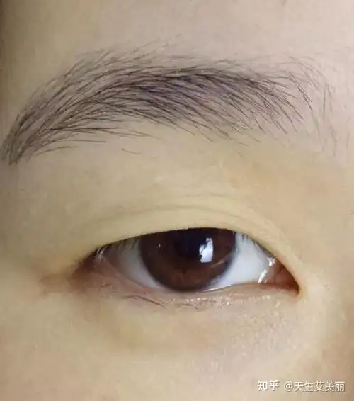 但恢复期长,且会留有一线状疤痕如果上睑没有皮肤松弛脂肪过厚的症状