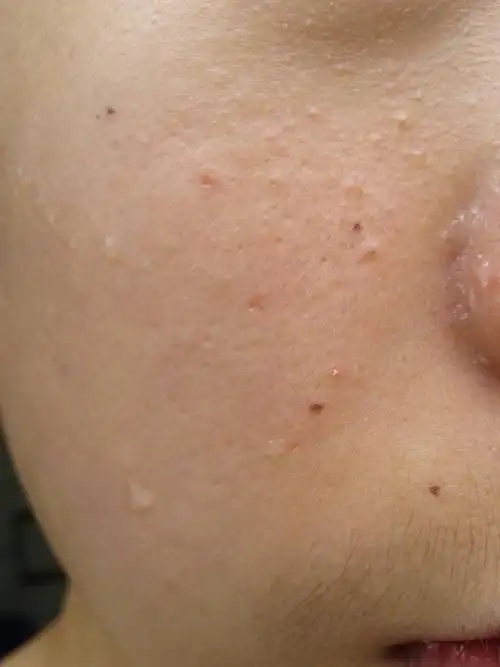 为什么我是男生15了,为啥现在的皮肤毛孔越来越大了以前都14岁的时候