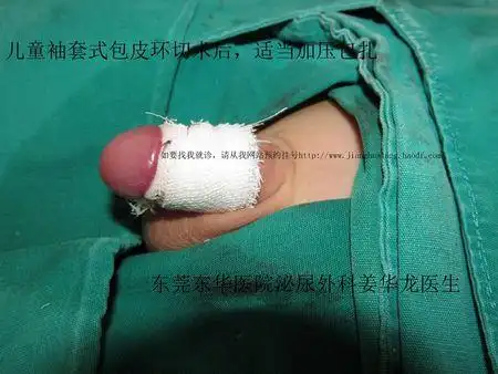 包皮环切术的手术麻醉