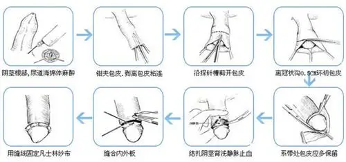 宁波包皮过长专家_宁波治疗包皮过长哪个专家好_宁波