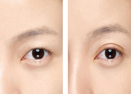 超声波双眼皮恢复期是多久-脾气seo