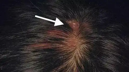 头皮上长"痘痘",竟然导致永久性脱发?不要怕,有它就能远离头秃!