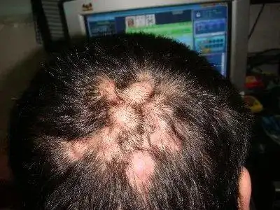 头皮的毛囊炎再不治你就秃了