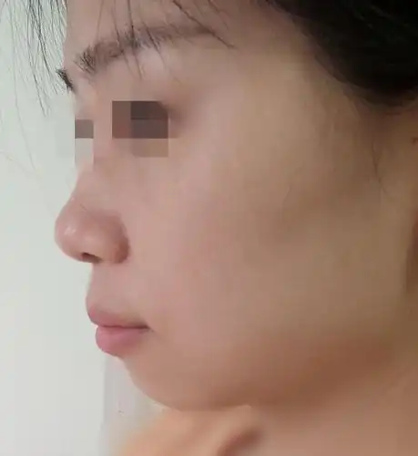 凸嘴骨性凸起侧脸难看这通过矫正侧脸可以改善吗